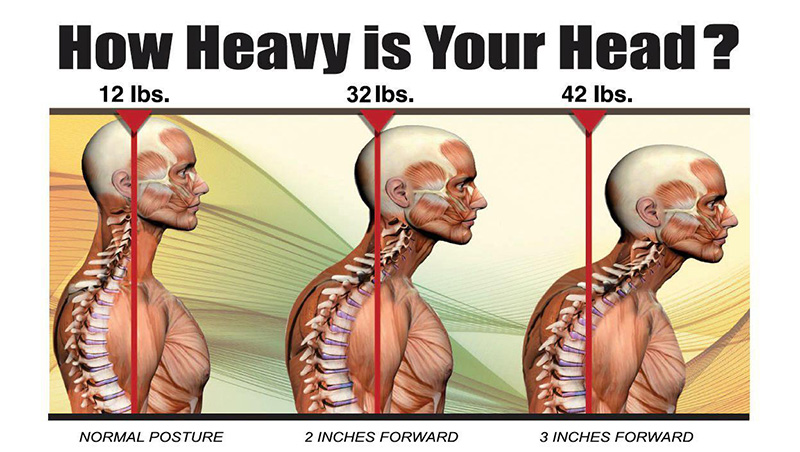 Is Your Head Posture to Blame for Your Neck Pain and Headaches?